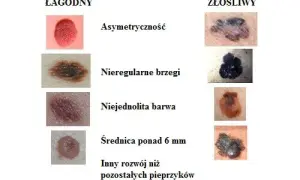 Kto bada pieprzyki? Dermatolog wyjaśnia, kiedy to konieczne i na co uważać