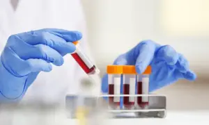 Co to jest ASO w badaniu krwi? Normy, interpretacja i znaczenie diagnostyczne