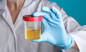 Co wykrywa badanie moczu? Choroby, które możesz zdiagnozować dzięki analizie