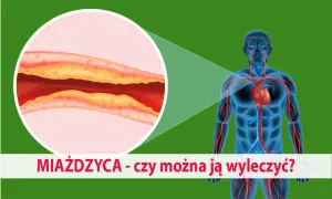 Zbliżenie na zatkaną miażdżycą tętnicę i schemat układu krwionośnego człowieka. Czy można ją wyleczyć?