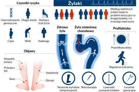 Grafika przedstawia żylaki na nodze, ich objawy, czynniki ryzyka (genetyka, tryb życia, ciąża, wiek, nadwaga) oraz profilaktykę (dieta, ćwiczenia, wyroby kompresyjne, skleroterapia, laser, operacja).