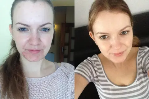 Przed i po kuracji izotekiem. Po lewej widoczne skutki uboczne leczenia trądziku: zaczerwienienia i wypryski. Po prawej gładka, czysta skóra.