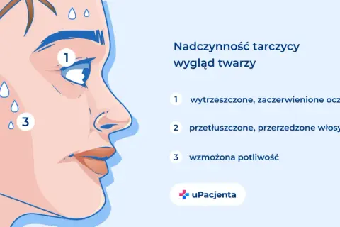 Nadczynność tarczycy wpływa na wygląd twarzy: wytrzeszczone oczy (1), przetłuszczone włosy (2) i wzmożona potliwość (3).