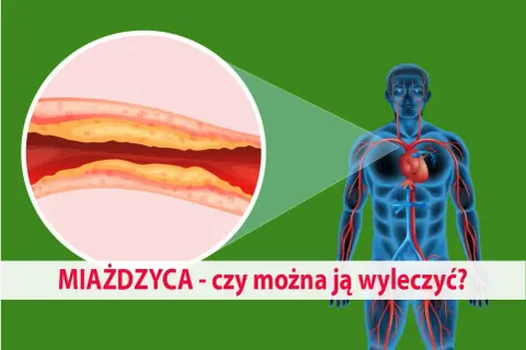 Zbliżenie na zatkaną miażdżycą tętnicę i schemat układu krwionośnego człowieka. Czy można ją wyleczyć?
