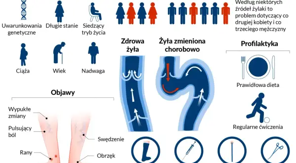Grafika przedstawia żylaki na nodze, ich objawy, czynniki ryzyka (genetyka, tryb życia, ciąża, wiek, nadwaga) oraz profilaktykę (dieta, ćwiczenia, wyroby kompresyjne, skleroterapia, laser, operacja).