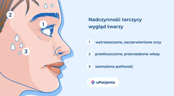 Nadczynność tarczycy wpływa na wygląd twarzy: wytrzeszczone oczy (1), przetłuszczone włosy (2) i wzmożona potliwość (3).