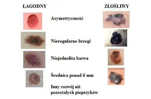 Kto bada pieprzyki? Dermatolog wyjaśnia, kiedy to konieczne i na co uważać