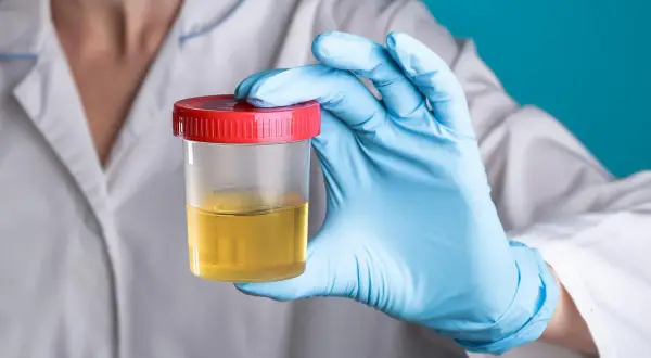 Co wykrywa badanie moczu? Choroby, które możesz zdiagnozować dzięki analizie