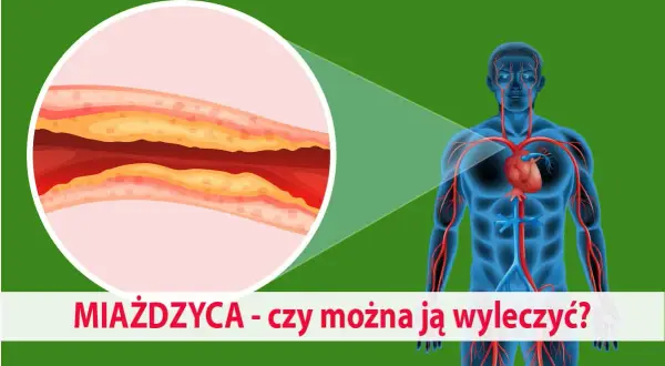 Zbliżenie na zatkaną miażdżycą tętnicę i schemat układu krwionośnego człowieka. Czy można ją wyleczyć?