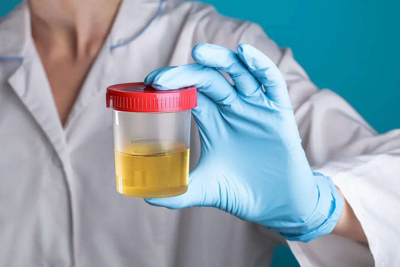 Co wykrywa badanie moczu? Choroby, które możesz zdiagnozować dzięki analizie