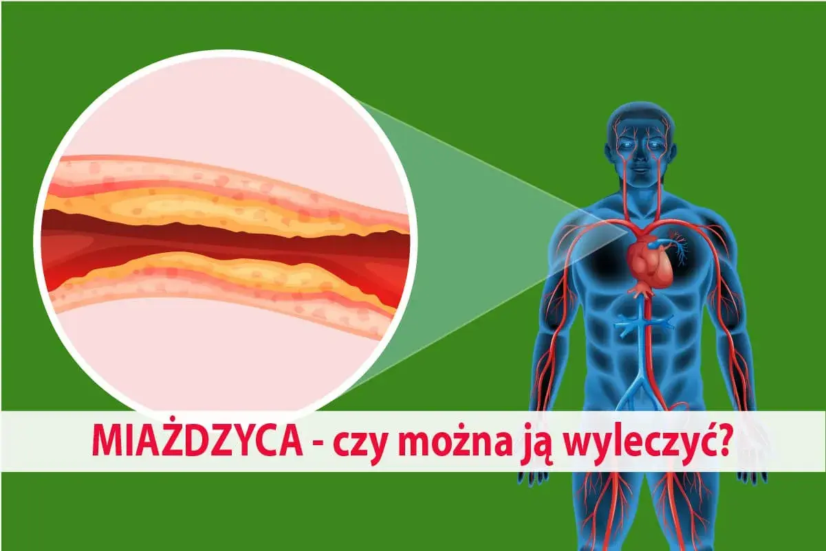 Zbliżenie na zatkaną miażdżycą tętnicę i schemat układu krwionośnego człowieka. Czy można ją wyleczyć?