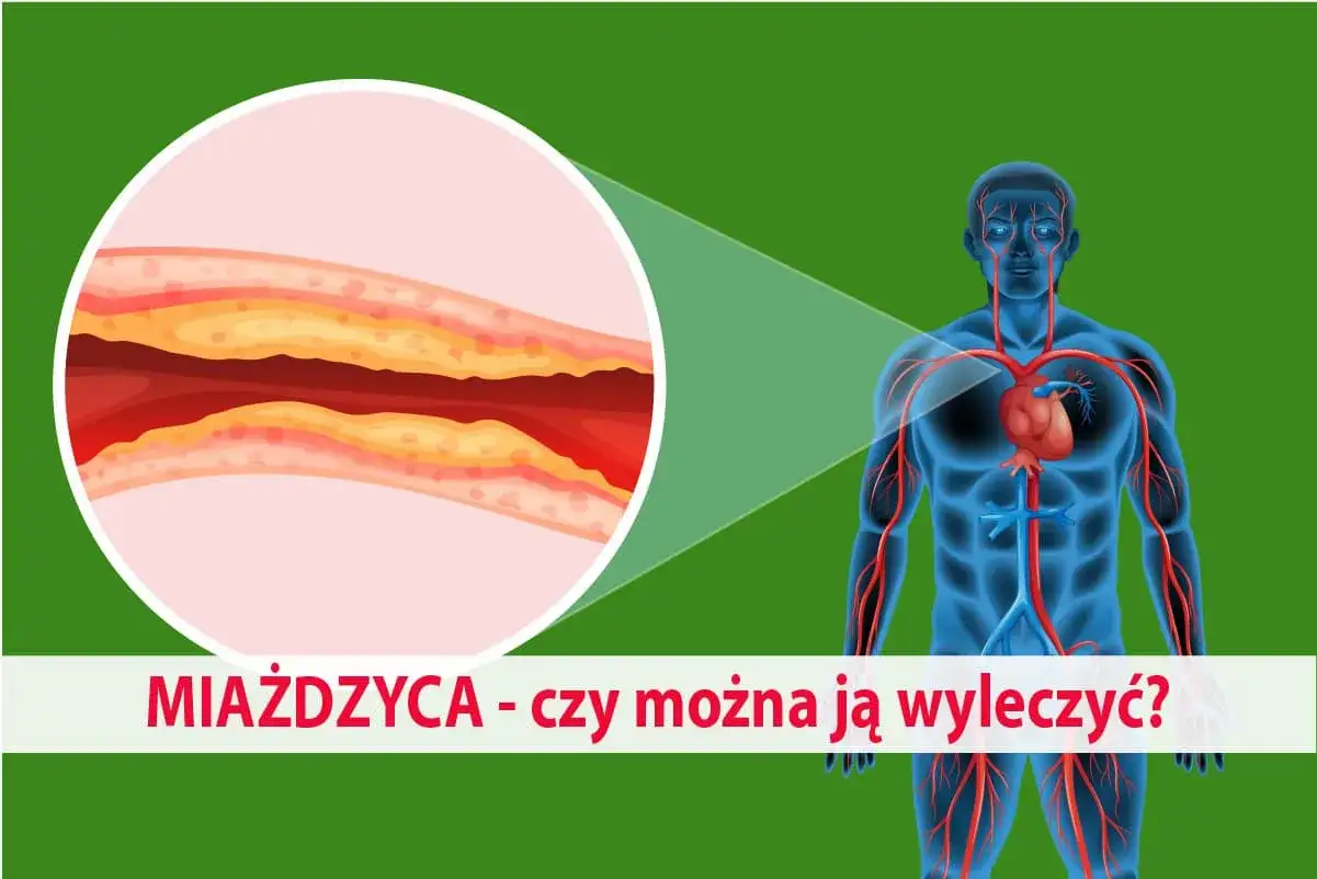 Zbliżenie na zatkaną miażdżycą tętnicę i schemat układu krążenia człowieka. Czy można ją wyleczyć?