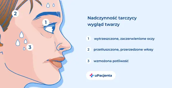Nadczynność tarczycy wpływa na wygląd twarzy: wytrzeszczone oczy (1), przetłuszczone włosy (2) i wzmożona potliwość (3).