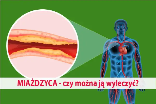 Zbliżenie na zatkaną miażdżycą tętnicę i schemat układu krwionośnego człowieka. Czy można ją wyleczyć?