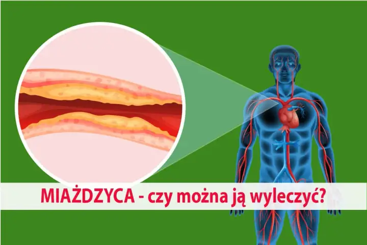 Zbliżenie na zatkaną miażdżycą tętnicę i schemat układu krwionośnego człowieka. Czy można ją wyleczyć?